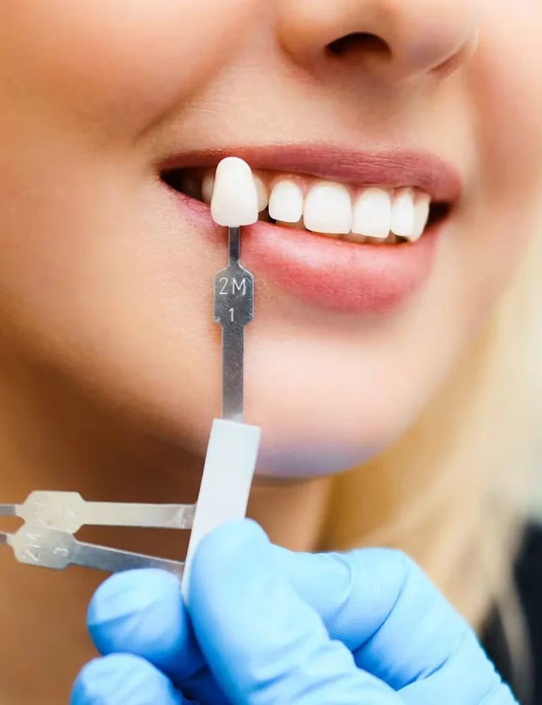 CEREC Same Day Crowns